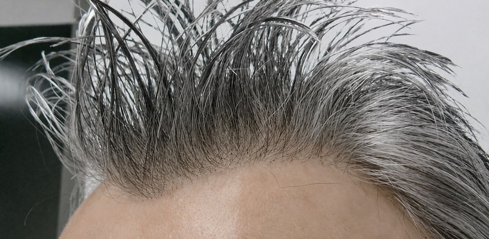 Xtreme Definition Hairline custom men's hair system example